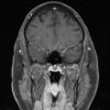 15A2 Vasculitis, SLE (Case 15) T1 W1 - Copy