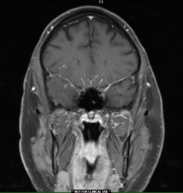 15A2 Vasculitis, SLE (Case 15) T1 W1 - Copy