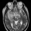 15A3 Vasculitis, SLE (Case 15) T2 1 - Copy