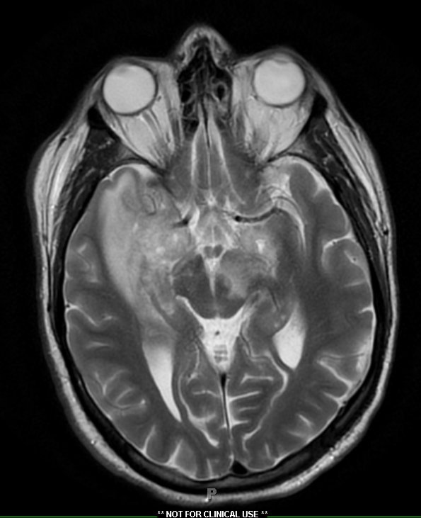 15A3 Vasculitis, SLE (Case 15) T2 1 - Copy