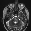 15A4 Vasculitis, SLE (Case 15) T2 W2 - Copy