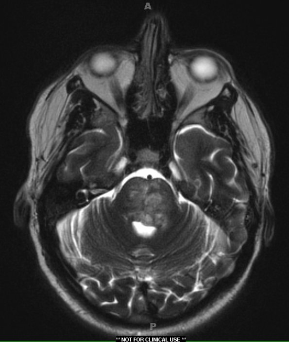 15A4 Vasculitis, SLE (Case 15) T2 W2 - Copy