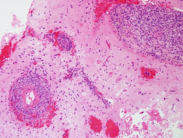 15B1 Vasculitis, SLE (Case 15) H&E 12