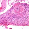 15B3 Vasculitis, SLE (Case 15) H&E 4