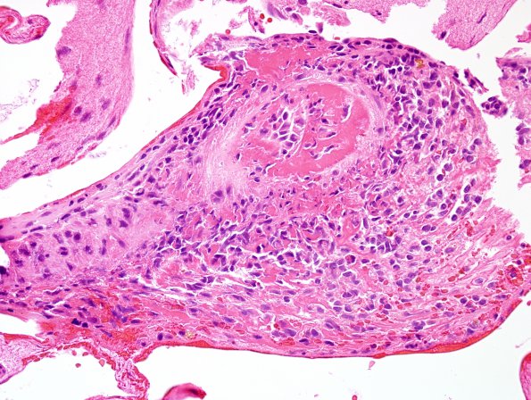 15B3 Vasculitis, SLE (Case 15) H&E 4