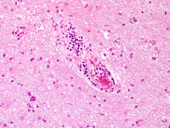 15B4 Vasculitis, SLE (Case 15) H&E 5