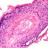 15B5 Vasculitis, SLE (Case 15) H&E 2