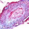 15B6 Vasculitis, SLE (Case 15) Trichrome 5.