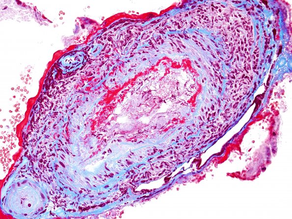 15B6 Vasculitis, SLE (Case 15) Trichrome 5.