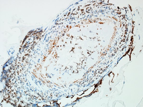 15B7 Vasculitis, SLE (Case 15) SMA 8.j