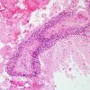 15C1 Vasculitis, SLE (Case 15) H&E 9