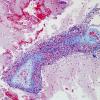 15C2 Vasculitis, SLE (Case 15) Trichrome 4.j