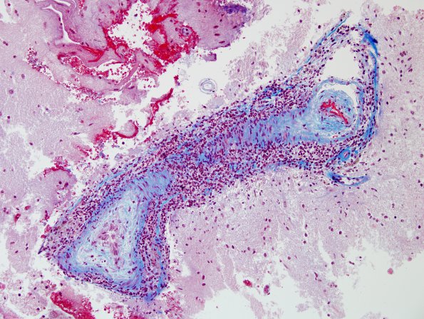 15C2 Vasculitis, SLE (Case 15) Trichrome 4.j