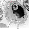 15D1 Vasculitis, SLE (Case 15) EM 1 - Copy