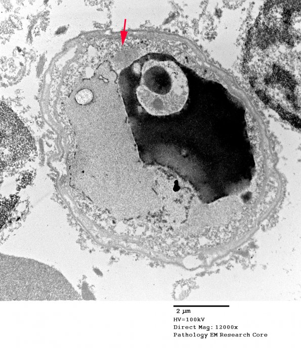 15D1 Vasculitis, SLE (Case 15) EM 1 - Copy