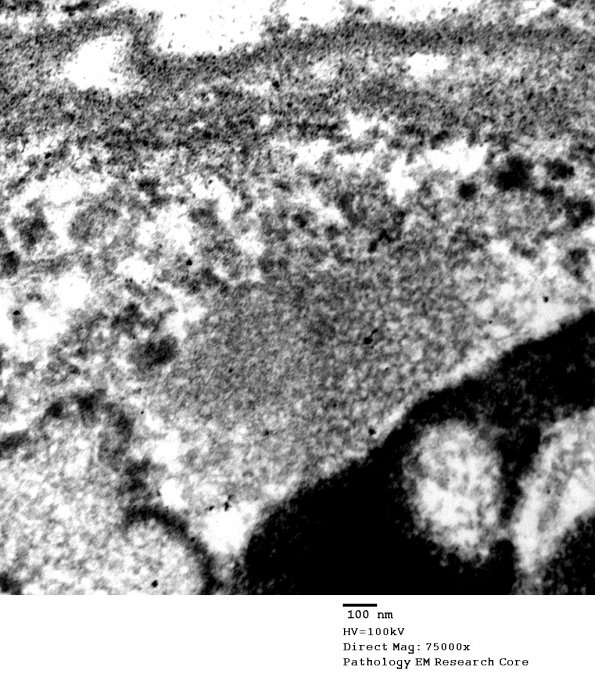 15D2 Vasculitis, SLE tubuloreticular inclusions (Case 15) EM 047 - Copy