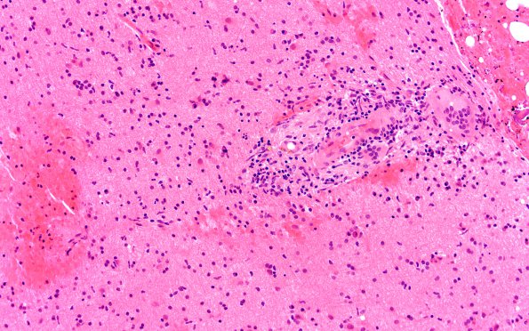 16A1 Granulomatous Angiitis (Case 16) A2 20X