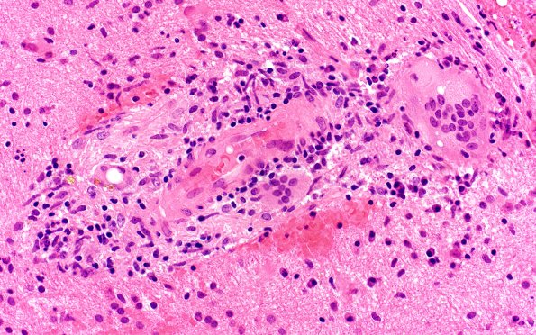 16A2 Granulomatous Angiitis (Case 16) A2 40X