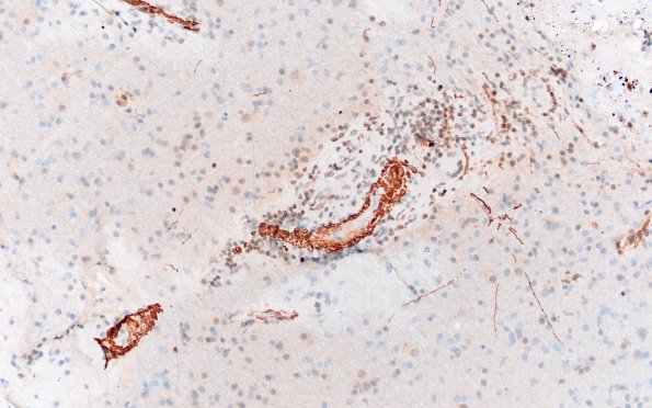 16C1 Granulomatous Angiitis (Case 16) A2 SMA 20X