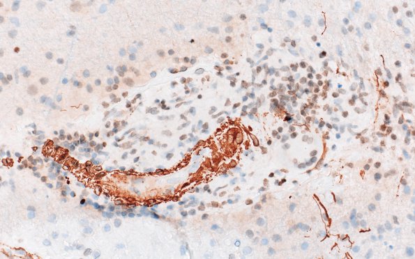 16C2 Granulomatous Angiitis (Case 16) A2 SMA 40X