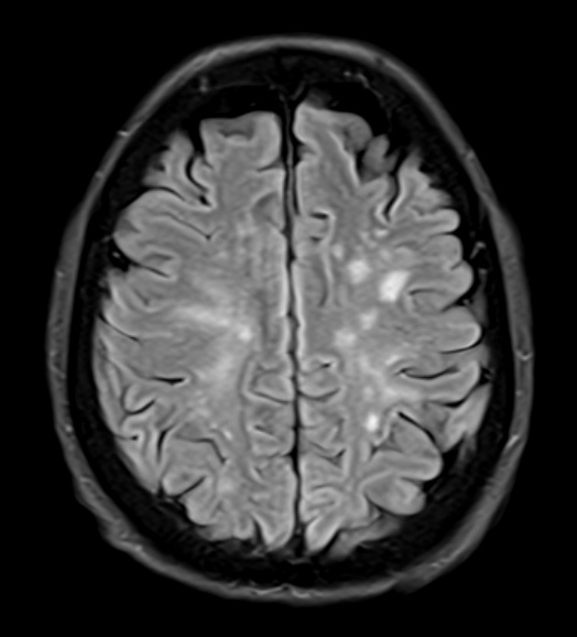 17A1 Vasculitis (Case 17) FLAIR - Copy