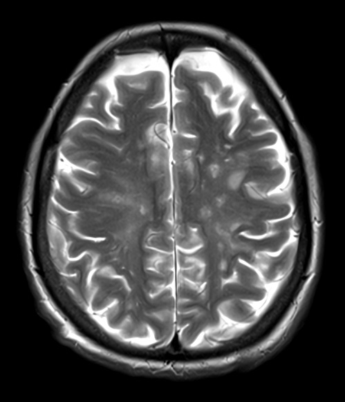 17A2 Vasculitis (Case 17) T2noC 2 - Copy