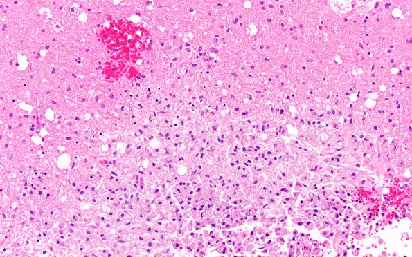 17B1 Vasculitis (Case 17) H&E 20x 1