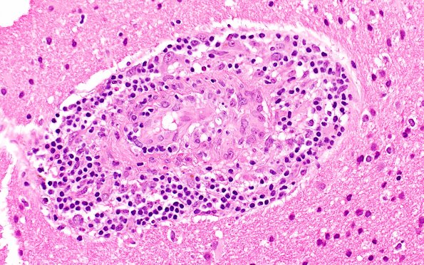 17B2 Vasculitis (Case 17) H&E 40x 3