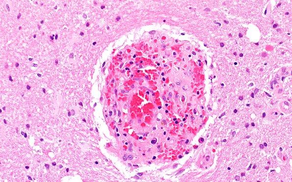 17B3 Vasculitis (Case 17) H&E 40x 4