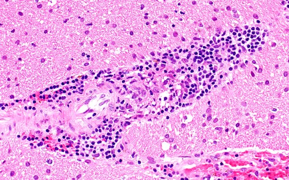 17B4 Vasculitis (Case 17) H&E 40x 2