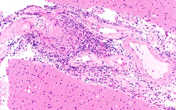 17B6 Vasculitis (Case 17) H&E 20x 2