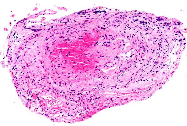 17B7 Vasculitis (Case 17) H&E 20x 4
