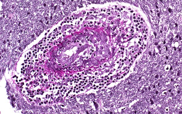 17C1 Vasculitis (Case 17) VVG 40X 2