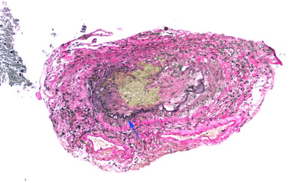 17C2 Vasculitis (Case 17) VVG 20X 3 copy