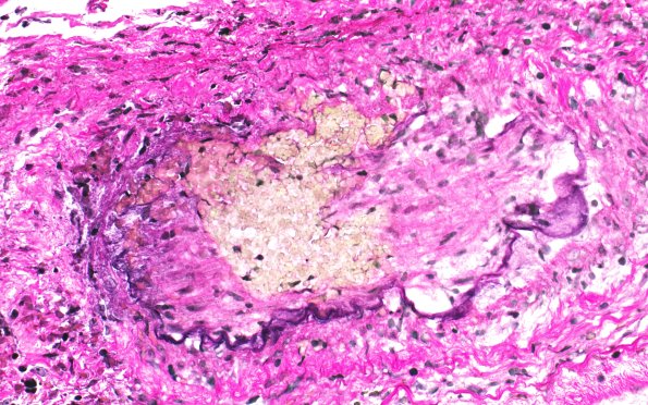 17C3 Vasculitis (Case 17) VVG 40X 4