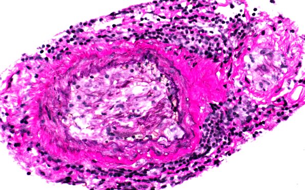 17C4 Vasculitis (Case 17) VVG 40X 3