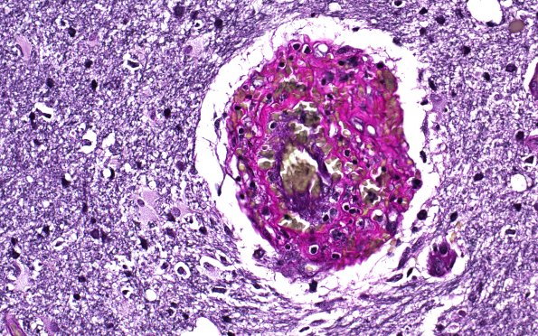 17C5 Vasculitis (Case 17) VVG 40X