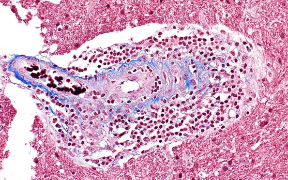 17D1 Vasculitis (Case 17) TRI 40X 1
