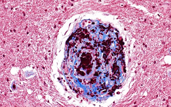 17D2 Vasculitis (Case 17) TRI 40X 2