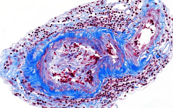 17D3 Vasculitis (Case 17) TRI 40X 4