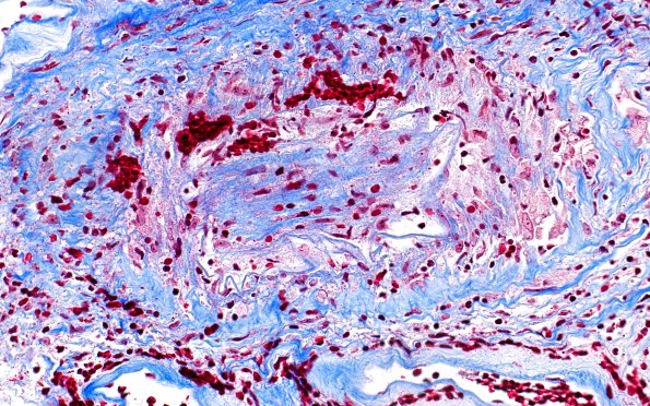 17D4 Vasculitis (Case 17) TRI 40X 3