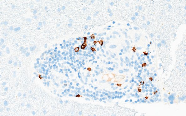 17E2 Vasculitis (Case 17) CD20 40X