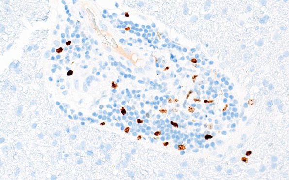 17F Vasculitis (Case 17) Ki67 40X