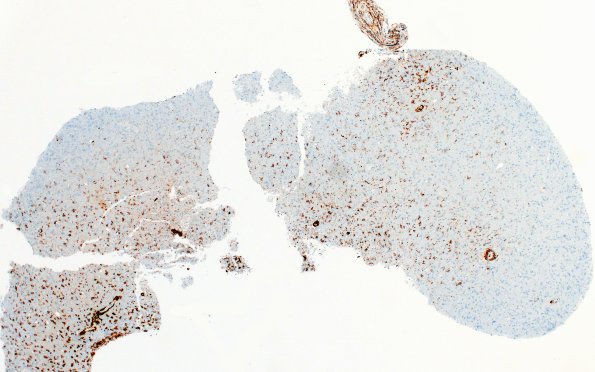 17G1 Vasculitis (Case 17) CD163 4X 1