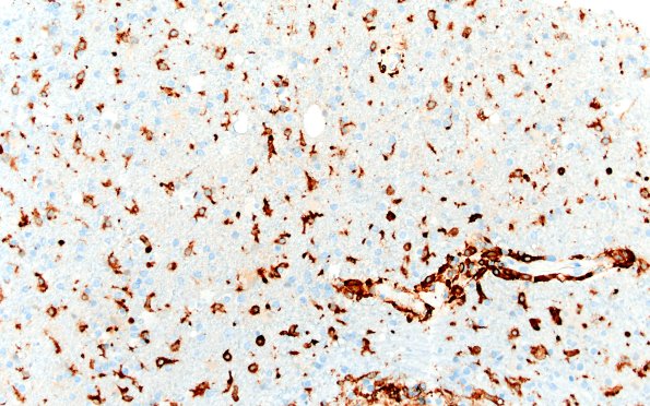 17G2 Vasculitis (Case 17) CD163 20X 1