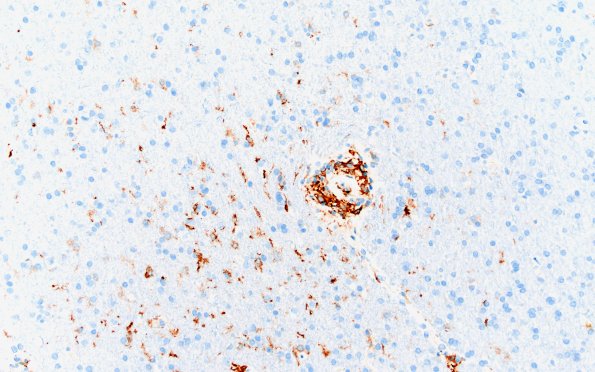 17G3 Vasculitis (Case 17) CD163 20X 1