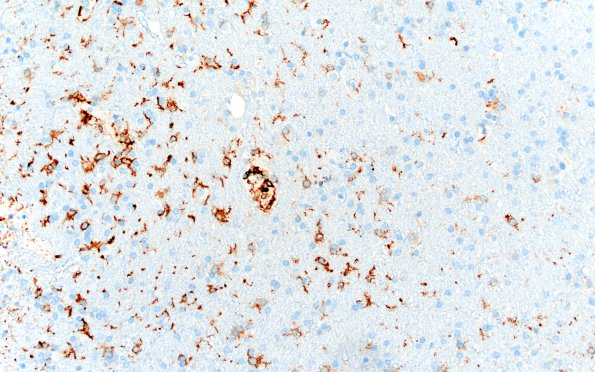 17G4 Vasculitis (Case 17) CD163 20X 1