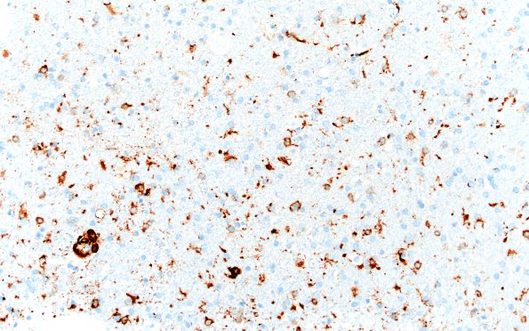 17G5 Vasculitis (Case 17) CD163 20X 1