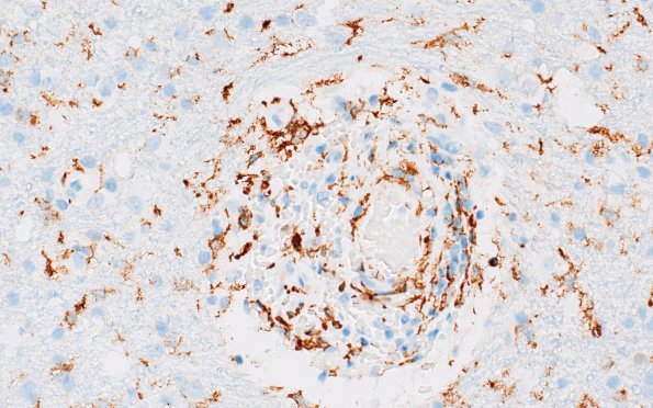 17G6 Vasculitis (Case 17) CD163 40X 2