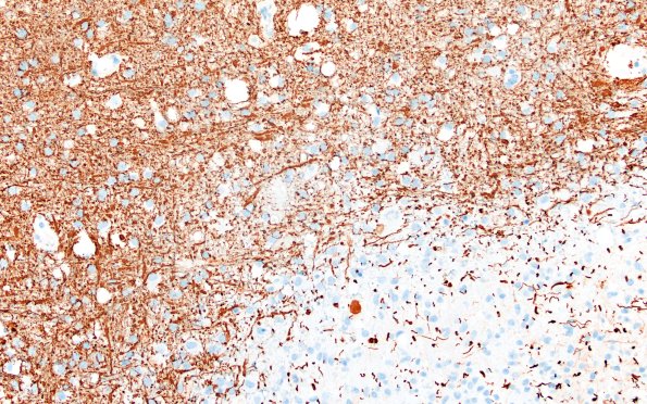 17H1 Vasculitis (Case 17) NF 20x 1
